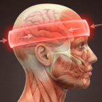 A medical diagram illustrating a tension headache as a glowing red band wrapping tightly around the forehead and sides of the head.