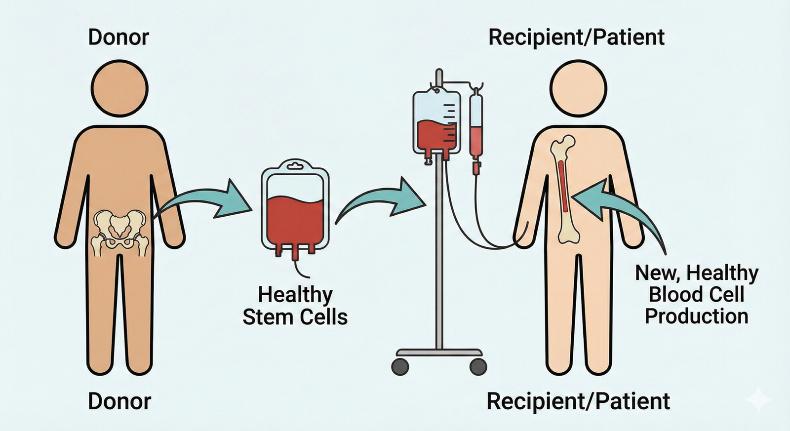 A simple infographic illustrating the bone marrow transplant process, from the donor to the collection of stem cells, and finally to the infusion into the patient to restart healthy blood cell production.