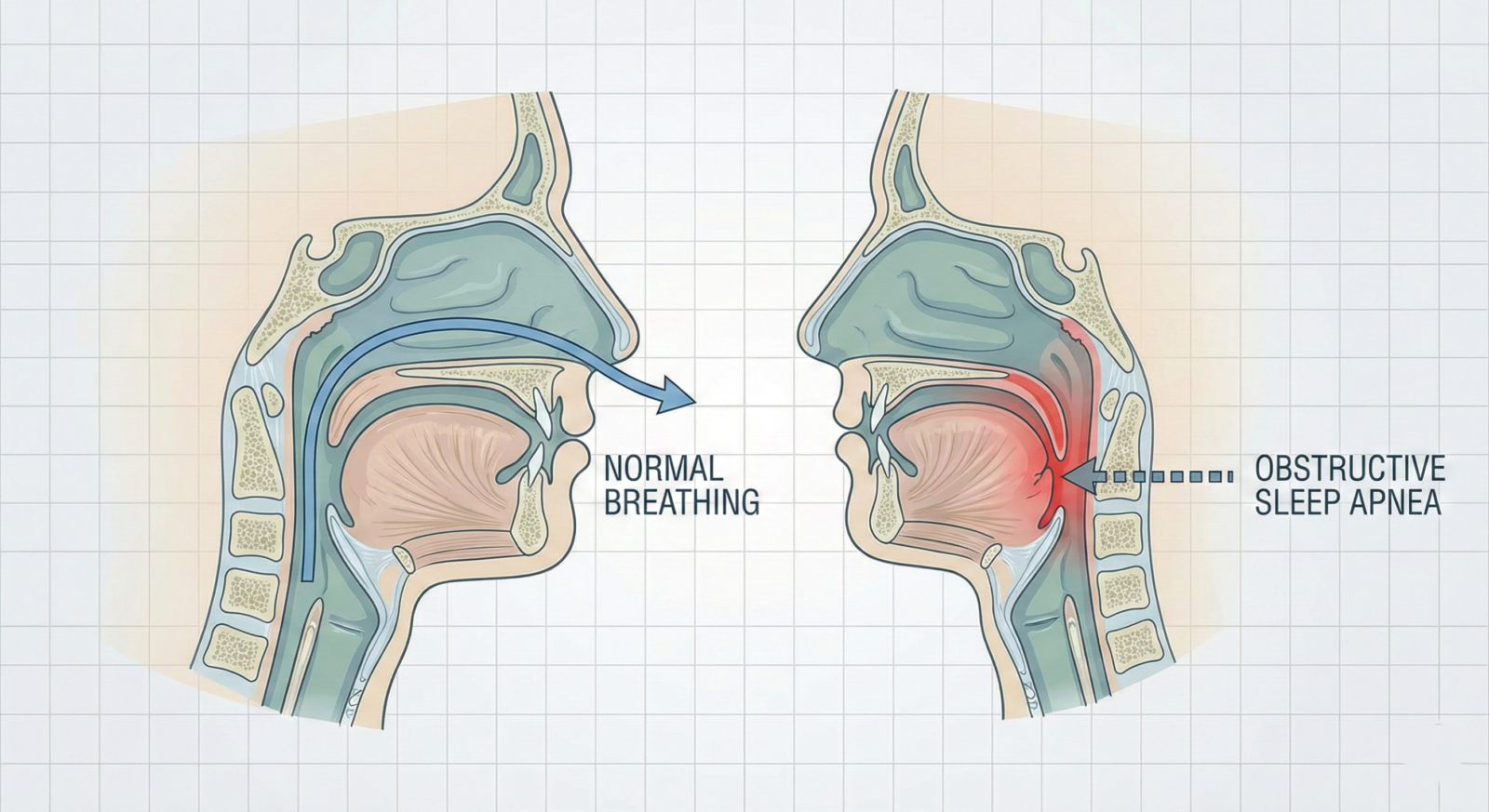 Medical illustration comparing a normal open airway with an obstructed airway characteristic of sleep apnea.